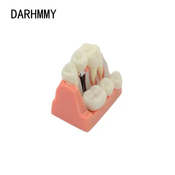 DARHMMY Dental Teach Implant Analysis Съемная модель корончатого моста, демонстрационная модель зубов, модель зубных имплантатов. 0