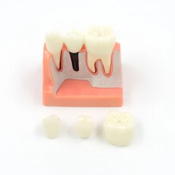 DARHMMY Dental Teach Implant Analysis Съемная модель корончатого моста, демонстрационная модель зубов, модель зубных имплантатов. 1