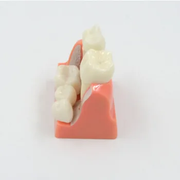 DARHMMY Dental Teach Implant Analysis Съемная модель корончатого моста, демонстрационная модель зубов, модель зубных имплантатов. 2