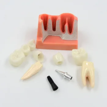 DARHMMY Dental Teach Implant Analysis Съемная модель корончатого моста, демонстрационная модель зубов, модель зубных имплантатов. 3